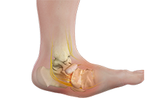 Charcot Foot Reconstruction