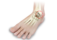 Foot and Ankle Arthritis