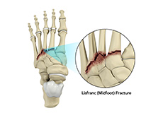 Lisfranc (Midfoot) Fracture