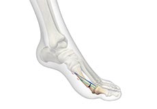 Minimally Invasive Bunion Surgery