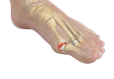 Hallux Rigiditis