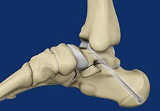 Subtalar Arthrodesis