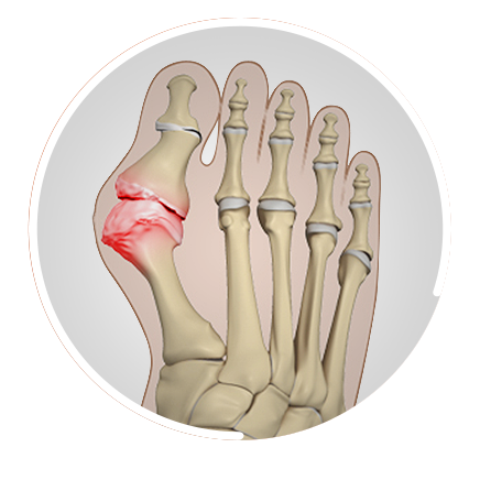 Foot & Ankle Arthritis